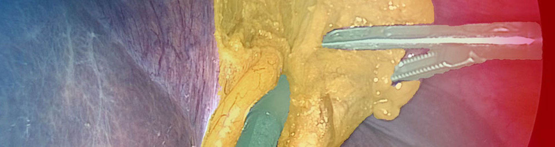 ImViA - Smart Video Annotation for Surgery ImViA - Smart Video Annotation for Surgery