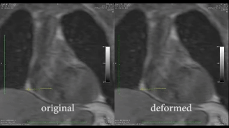 Kompensation von Herzbewegungen in 3D-MR-Zeitreihen 